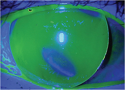 Figure 1. A less-than-ideal GP lens fit OD.