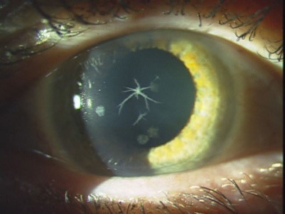 Figure 1. Anterior stromal corneal opacities.