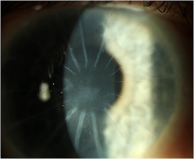 Figure 2. The patient’s cornea post-superficial keratectomy.