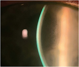Figure 1. Corneal edema post scleral lens wear.