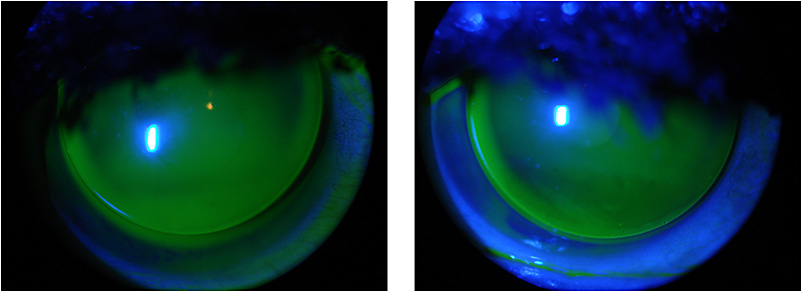 Rgp Staining Pattern Contact Lens Spectrum | PentaVision
