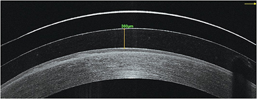 FIGURE 4. Scleral lenses can be filled with topical medications to help heal corneal complications from severe ocular allergy.