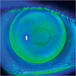 Figure 1. A well-centered aspheric multifocal GP lens.