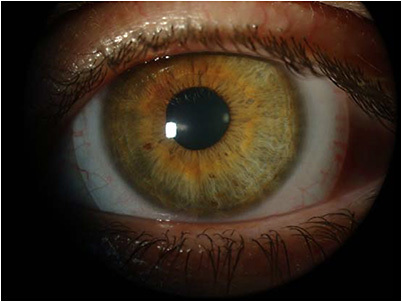 Figure 7. Normal gaze and the tear meniscus.