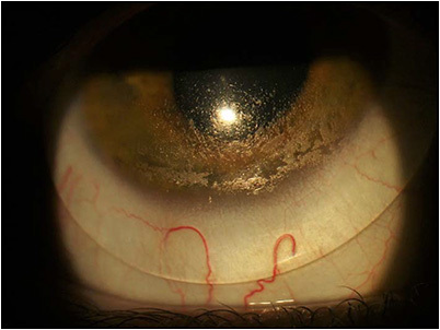 Figure 2. Slit lamp observation of localized deposits at the lower, anterior surface.