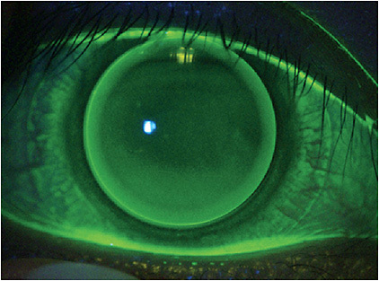 FIGURE 2. Properly fitting aspheric GP lens.