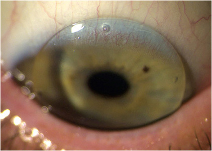 FIGURE 3. Adequate translation with a translating GP multifocal.