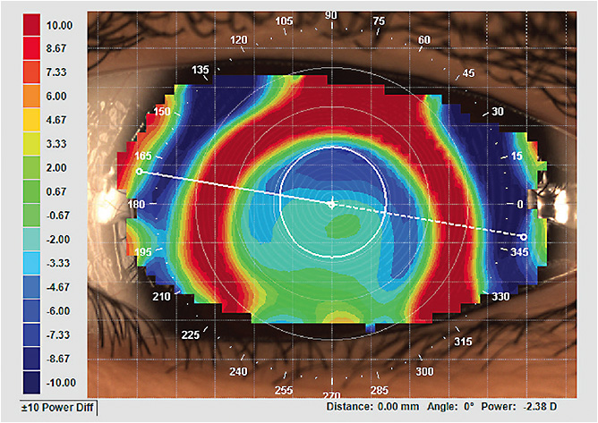 Contact Lens Spectrum | PentaVision