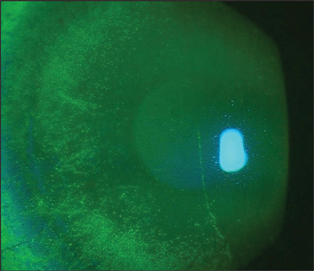Contact Lens Spectrum | PentaVision