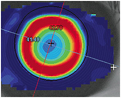 Figure 1. In myopic orthokeratology, the cornea is primarily reshaped by movement of epithelial intracellular fluid from the central treatment zone into the adjacent reverse zone.