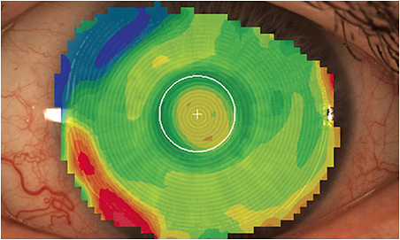 FIGURE 5. This image shows the results after decentering the optics on the scleral lens from Figure 4.