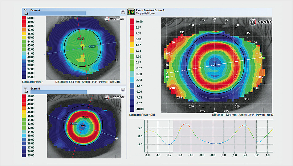 Contact Lens Spectrum | PentaVision