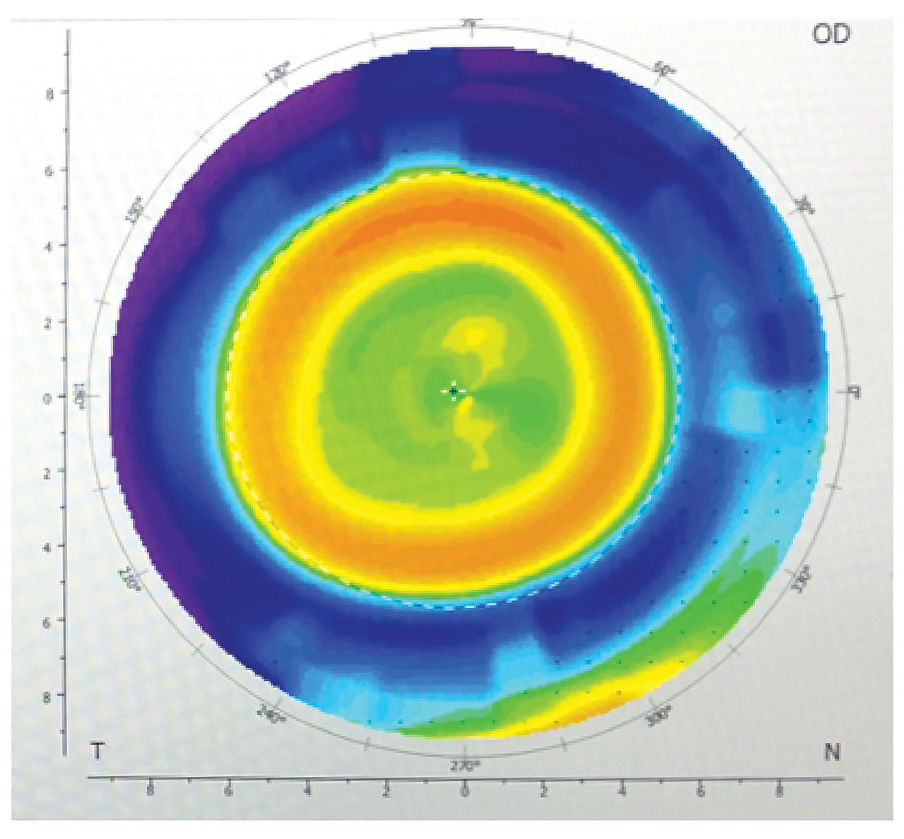 ORTHOKERATOLOGY TODAY Contact Lens Spectrum