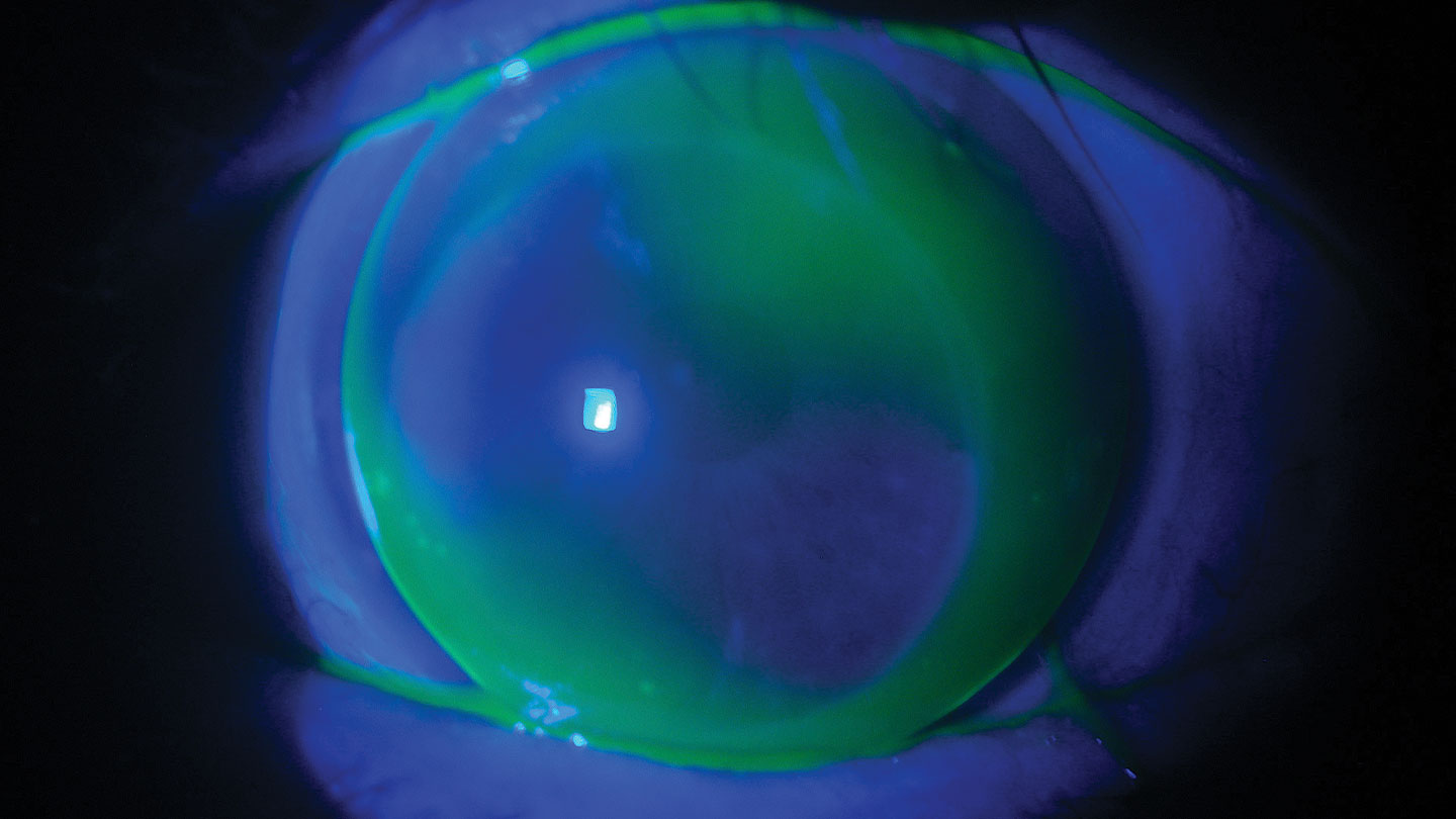 Online Photo Diagnosis: Post-Graft Alternatives to Scleral Lenses ...