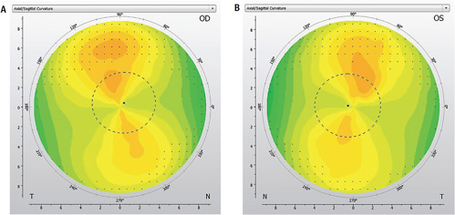 FIGURE 2. Regular with-the-rule astigmatism OD and OS.