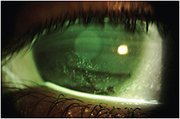 Figure 2. Significant corneal healing with only moderate persistent epithelial erosion after eight weeks on topical ophthalmic cenegermin.