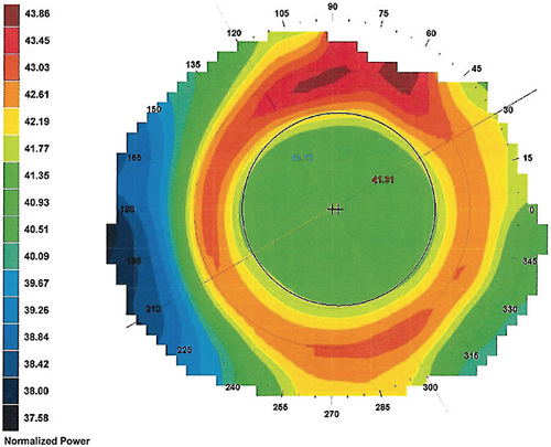 FIGURE 1. Topography of a cornea fitted with a regular ortho-k lens design. Note that most of the red ring (“add”) lies outside of the pupil area (black circle).