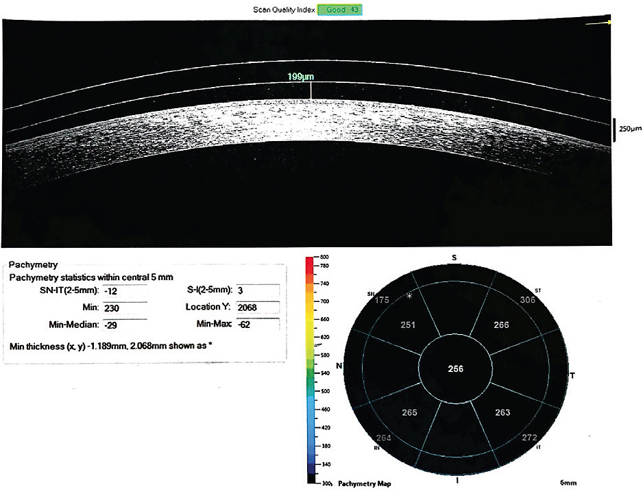 Contact Lens Spectrum PentaVision
