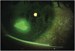 Figure 1. Initial para-central neurotrophic defect measuring 2mm x 3mm.