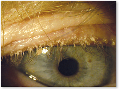 Contact Lens Spectrum | PentaVision