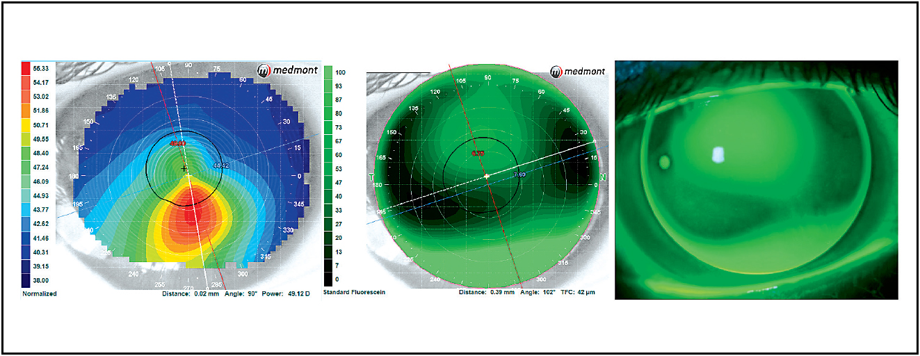 Contact Lens Spectrum PentaVision