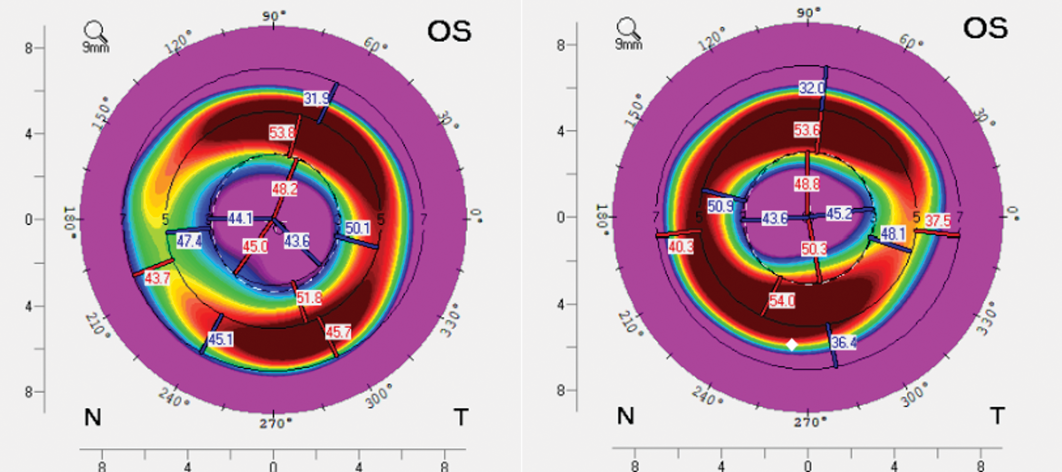 Lens Demands Astigmatism in Ortho-k: When Vision Quality Demands Design Precision ...