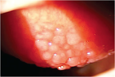 FIGURE 2. Tarsal giant papillae are characteristic of severe ocular allergy vernal keratoconjunctivitis.