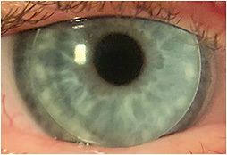 Figure 2. Corneal GP lens with no induced corneal edema.